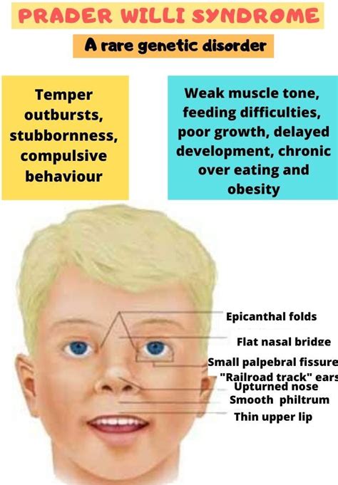 prada wilson syndrome|prader willi syndrome ncbi.